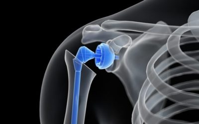 What is Total Shoulder Replacement?