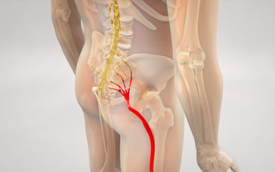 Sciatica – Causes and Risk Factors that help Identify the Condition