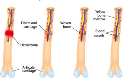 What is the Bone Healing Process?