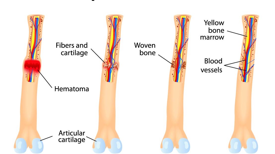 Fracture Care Treatment: When Is A Cast Not Good Enough?, 58% OFF