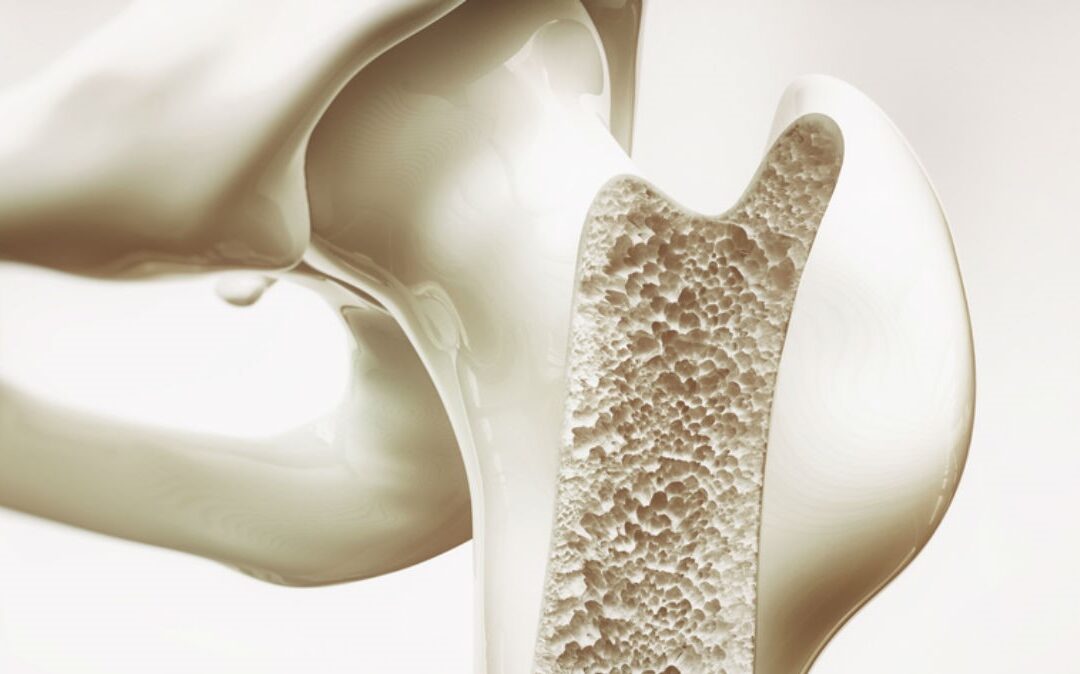 What is Osteoporosis? How do I prevent it and have healthy bones?
