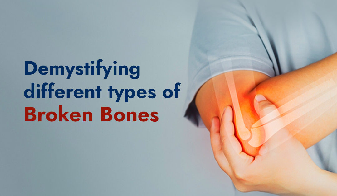 Demystifying different types of Broken Bones