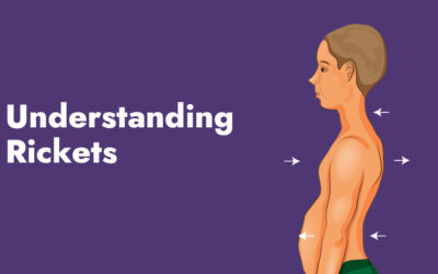 Understanding Rickets