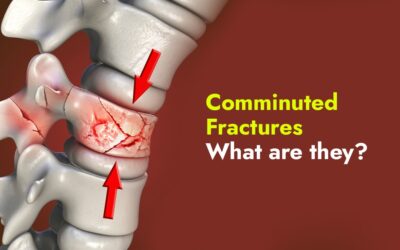 Comminuted Fractures – What are they?