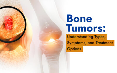 Bone Tumors: Understanding Types, Symptoms, and Treatment Options