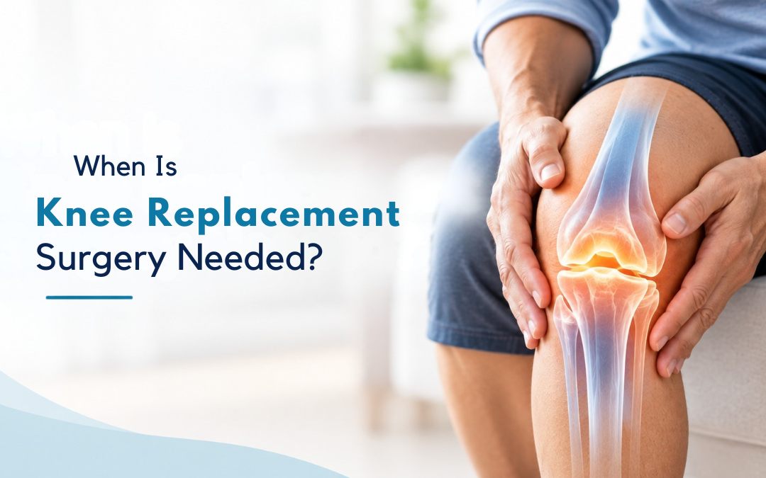 When Is Knee Replacement Surgery Needed?